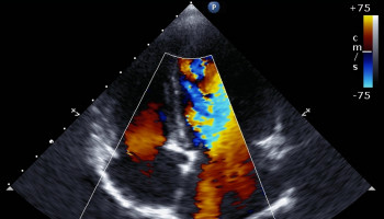 Pulmonary Hypertension