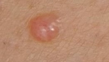 Difficult to Diagnose Melanomas Outcome Improvement Activity