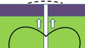 Ellipses and suture techniques Outcome Improvement Activity