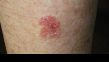 Topical treatment and medico-legal issues for skin cancer medicine