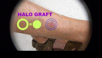 Biopsy, Haemostasis and Halo grafting for skin cancer medicine