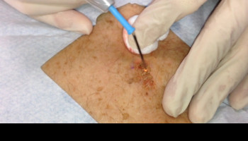 Currettage and Cautery for skin cancer medicine